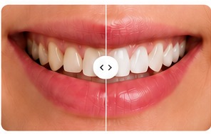 Caso de estética dental