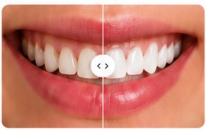 Caso de estética dental